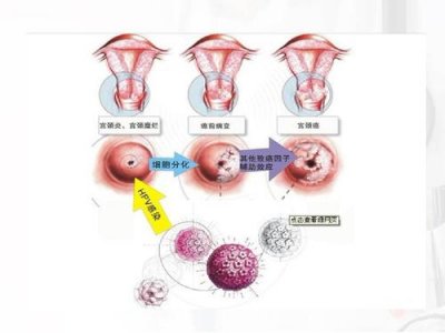 ​出现宫颈癌的五个征兆（这六个明显信号提示你可能是宫颈癌）