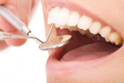 ​洗牙一次大概多少钱（洗牙结石需要多少钱）