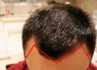 m型发际线能剃寸头吗(m型发际线适合寸头吗)