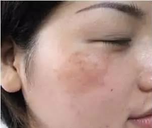 黄褐斑的形成原因及分类(黄褐斑是怎么形成的)(1)