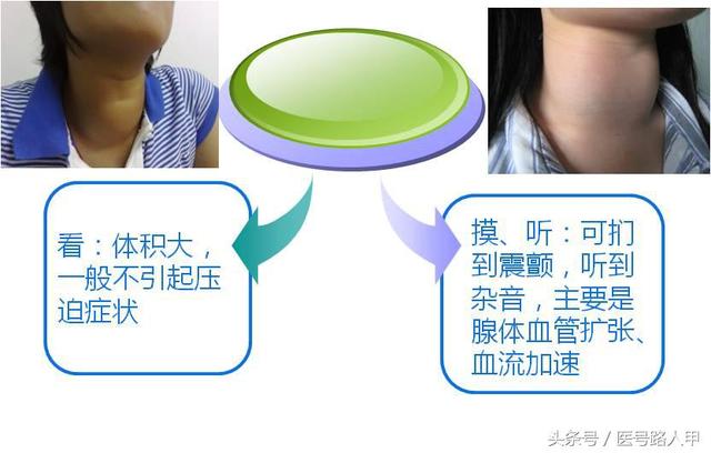 甲亢三大表现及特征(5大临床表现提示你可能得了甲亢)(5)