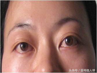 甲亢三大表现及特征(5大临床表现提示你可能得了甲亢)(6)