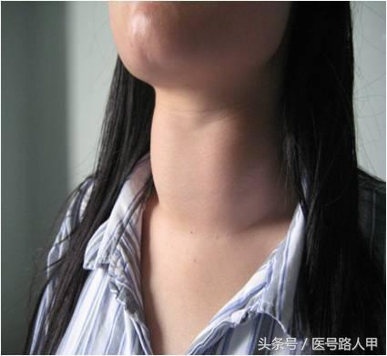 甲亢三大表现及特征(5大临床表现提示你可能得了甲亢)(4)