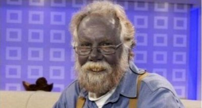 ​世界上实在存留的蓝种人，浑身皮肤呈蓝色