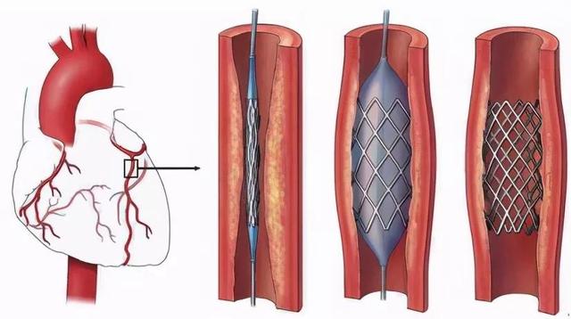 心脏支架从1.3万降至700元的原因(心脏支架从1.3万降至700元)(4)