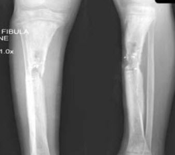广州女孩患骨膜增生厚皮症,面部褶皱如古稀老翁(染色体显性遗传)