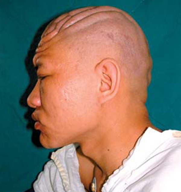 广州女孩患骨膜增生厚皮症,面部褶皱如古稀老翁(染色体显性遗传)