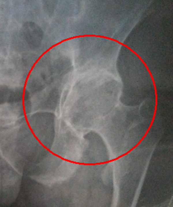 广州女孩患骨膜增生厚皮症,面部褶皱如古稀老翁(染色体显性遗传)