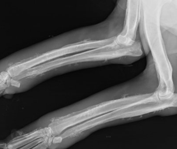 广州女孩患骨膜增生厚皮症,面部褶皱如古稀老翁(染色体显性遗传)