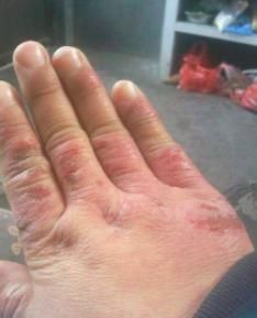 冬季防寒防冻安全知识,冬天到了,手怎样防冻啊?图2