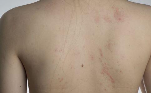 皮肤过敏的症状有哪些表现（4个皮肤过敏的症状）(2)