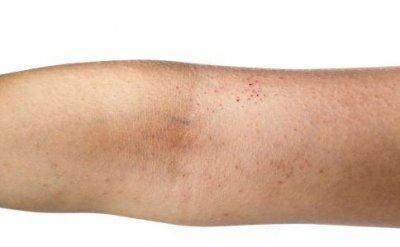 ​皮肤过敏的症状有哪些表现（4个皮肤过敏的症状）