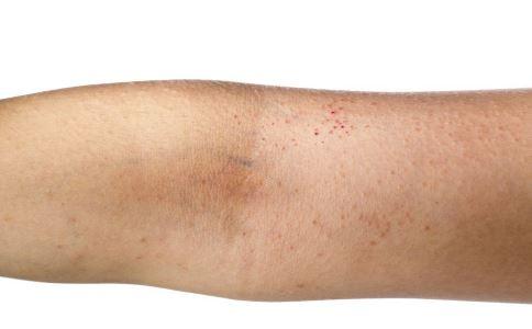 皮肤过敏的症状有哪些表现（4个皮肤过敏的症状）(1)