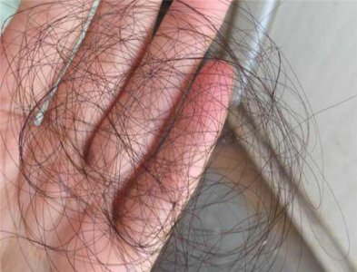 ​掉头发吃什么维生素 何如慢解掉头发的状况