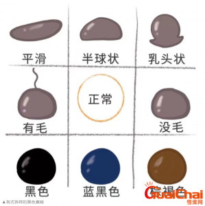 痣与黑色素瘤怎么区分?身上有痣需不需要点掉?