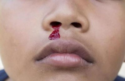小孩流鼻血怎么办最快止血方法(小孩流鼻血怎么办?三妙招有效止血!)