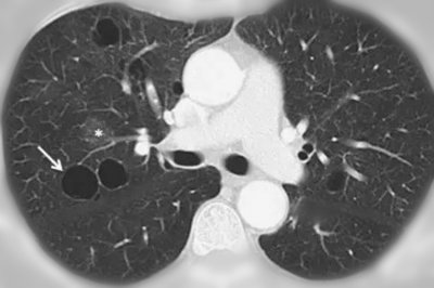 肺大泡是什么病严重吗(什么是肺大疱?被查出肺大疱应该怎么办?医生告诉您答