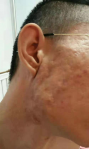 痤疮瘢痕 长痘留下难看的疤痕前,没人告诉你这些