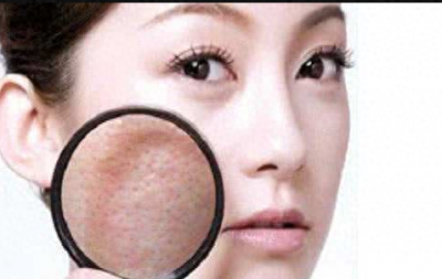 四种毛孔粗大类型!!你是哪一种?
