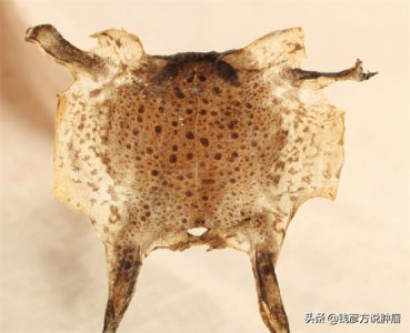 蟾蜍皮能治疗癌症吗 原来癞蛤蟆皮也能用于抗癌,比如这名10年未复发的胃间质瘤