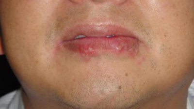 嘴上长泡怎么办(嘴上起泡了,痛苦难忍?怎样做才能快速消除,能不能挑破了?