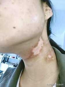 醋治好了我的白斑(“醋治好了我的白癜风”,是真是假?)