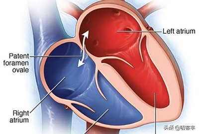 什么是卵圆孔未闭?