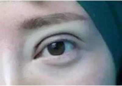 割双眼皮花了3万块 我做了双眼皮花了28000贵吗