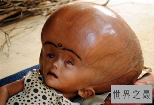 世界人类史上十大怪胎，女童如外星人