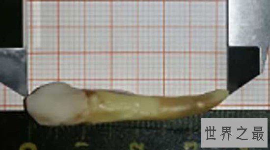 世界上最长的牙齿,拔下来后发现长达3.67厘米