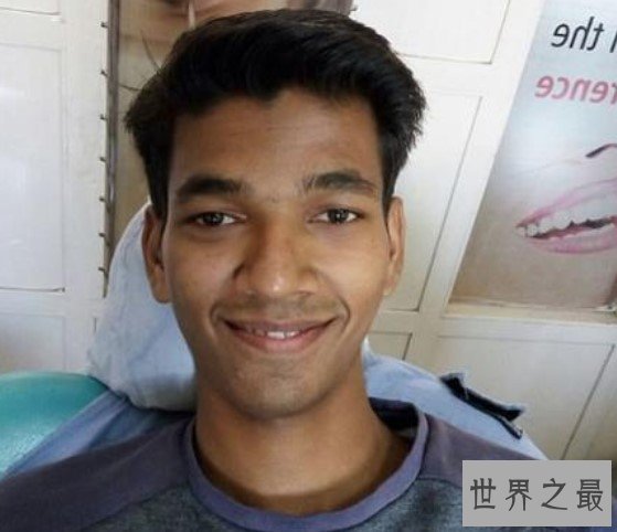 世界上最长的牙齿,拔下来后发现长达3.67厘米