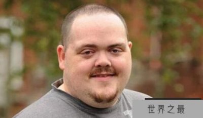 ​世界上眼球最突出的人：约翰·道尔，眼睛凸出12毫米