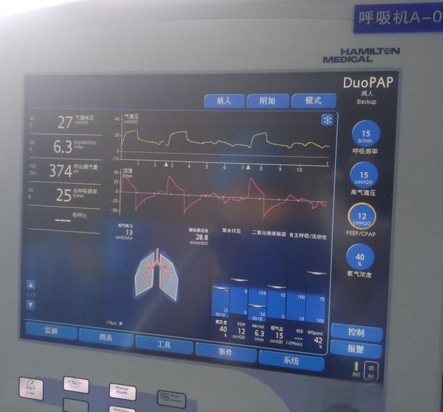 ICU中的呼吸机到底多贵,真是每天费用过万吗?重症医生说实话了-