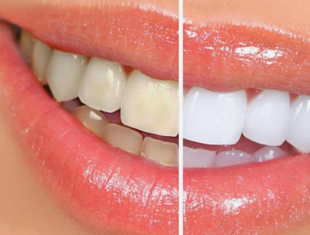 牙贴可以贴着睡觉吗?牙贴可以过夜吗 牙贴可以贴着睡觉吗?牙贴可以过夜吗