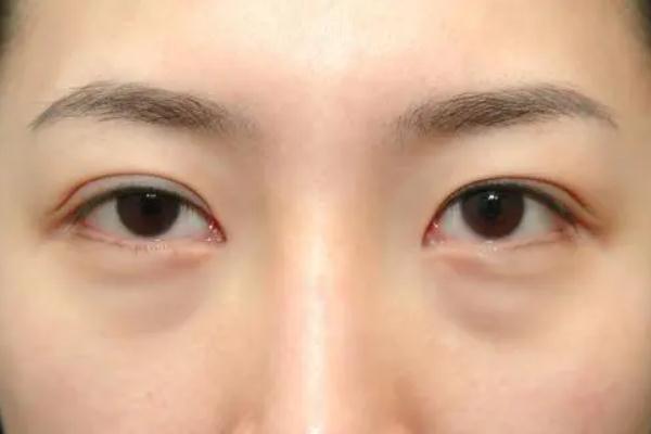 眼袋怎么去除最有效果 眼袋的形成原因 眼袋怎么去除最有效果 眼袋的形成原因