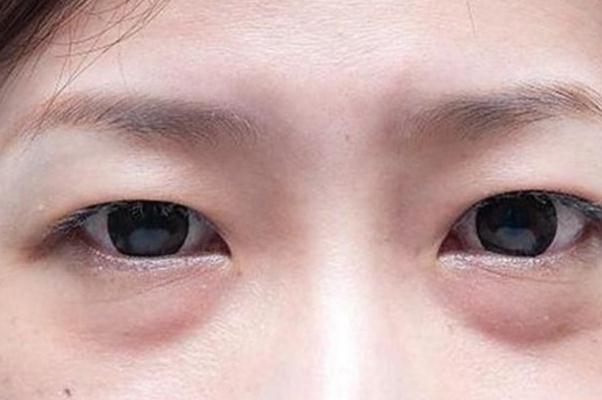 眼袋怎么去除最有效果 眼袋的形成原因 眼袋怎么去除最有效果 眼袋的形成原因