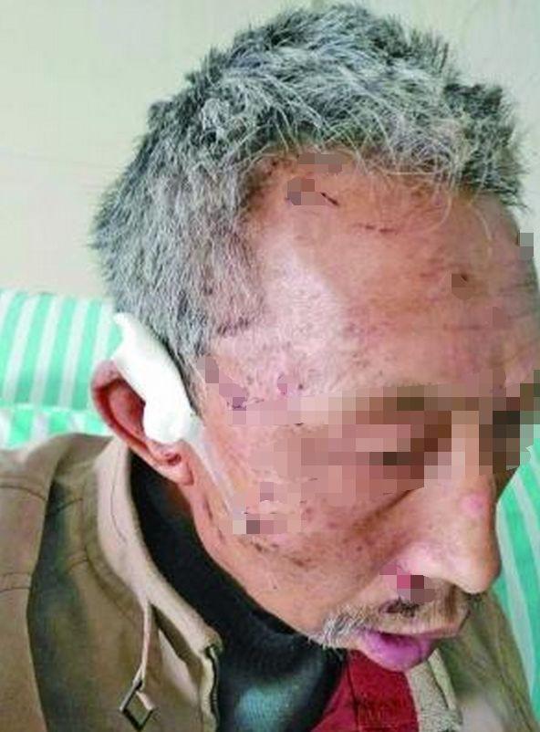 60岁大爷山上血战野猪三小时,昏迷三次,被咬醒三次!