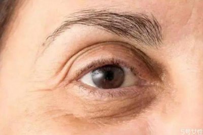 ​去除眼袋的方法有什么呢 如何可以快速去眼袋呢