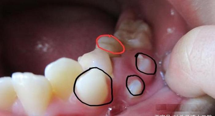 正常人有多少颗牙齿?传说32颗牙齿是富贵命,是真的吗?