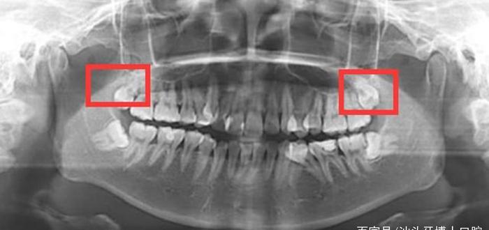 正常人有多少颗牙齿?传说32颗牙齿是富贵命,是真的吗?