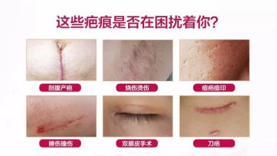 祛疤膏哪个牌子好?十款知名度最高的祛疤产品