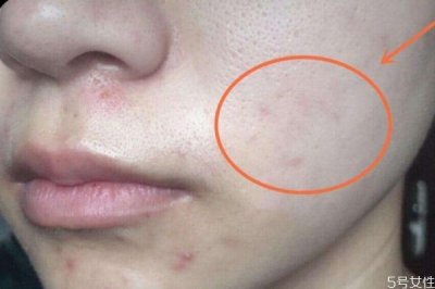 黑色痘印能自己消失吗 黑色痘印自己可以消失吗