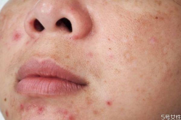 黑色痘印能自己消失吗 黑色痘印自己可以消失吗 黑色痘印能自己消失吗 黑色痘印自己可以消失吗