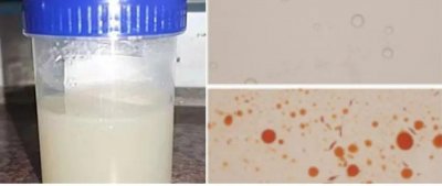 米汤尿 (乳糜尿)