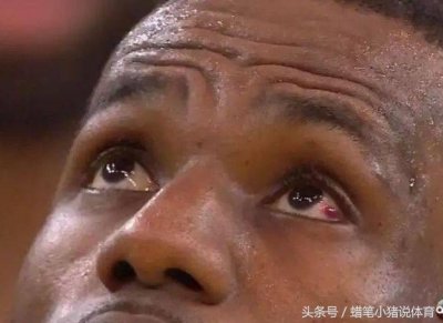 ​霸气侧漏！詹姆斯公布眼睛最新进展，勇士尽管放马过来吧