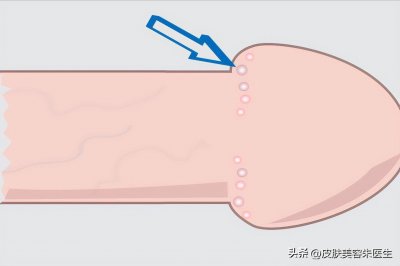 如何分辨珍珠疹和尖锐湿疣?主要看5点区别,看完就能轻松分辨
