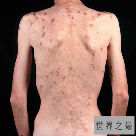 盘点世界五大绝症,如不解决恐毁灭人类