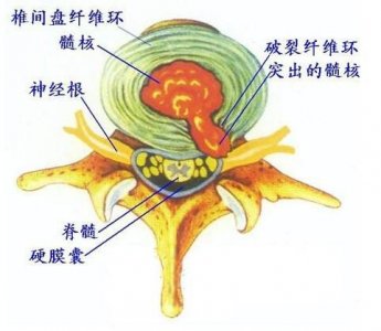 腰椎突出严重怎么办怎么治疗(腰间盘突出怎么治疗,不花钱在家就可以解决)