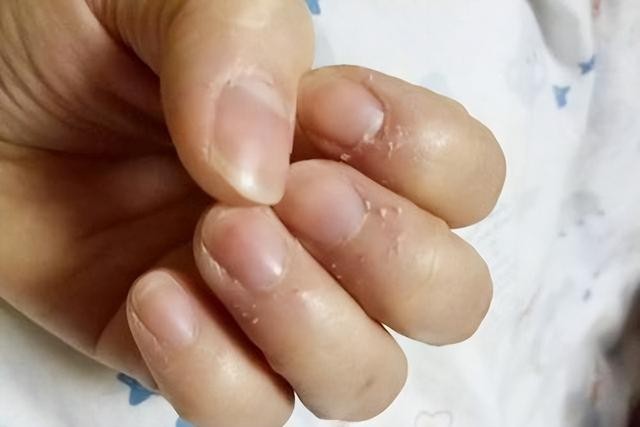 指甲上的倒刺是缺什么维生素（指甲周围长倒刺）(2)