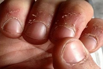 指甲上的倒刺是缺什么维生素(指甲周围长倒刺)